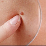 Mengungkap Kaitan Parasite dan Papiloma dalam Kesehatan Kulit