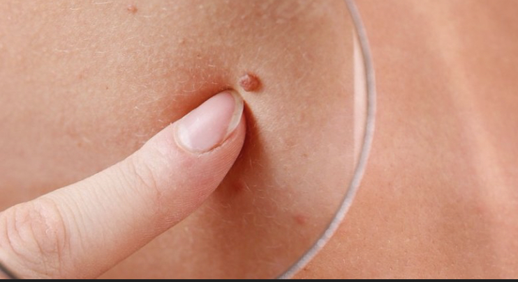 Mengungkap Kaitan Parasite dan Papiloma dalam Kesehatan Kulit